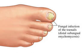 Onicomicosis